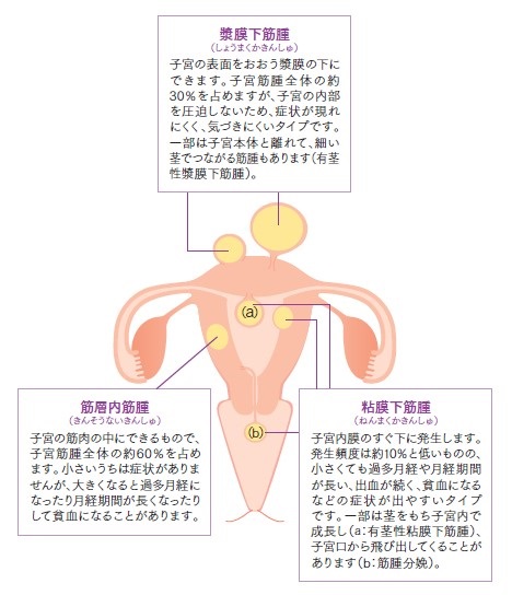 筋腫 子宮 子宮筋腫の変性